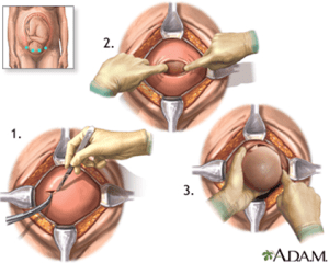 Proceso de cesarea